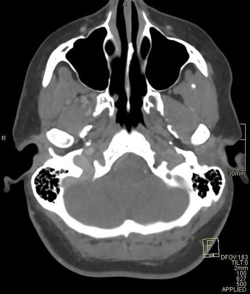File:Cerebral venous sinus thrombosis (Radiopaedia 91329-108965 Axial venogram 15).jpg