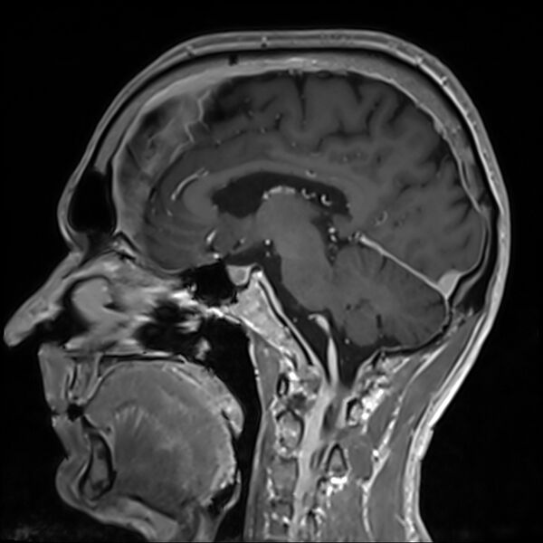 File:Cervical dural CSF leak on MRI and CT treated by blood patch (Radiopaedia 49748-54995 G 50).jpg