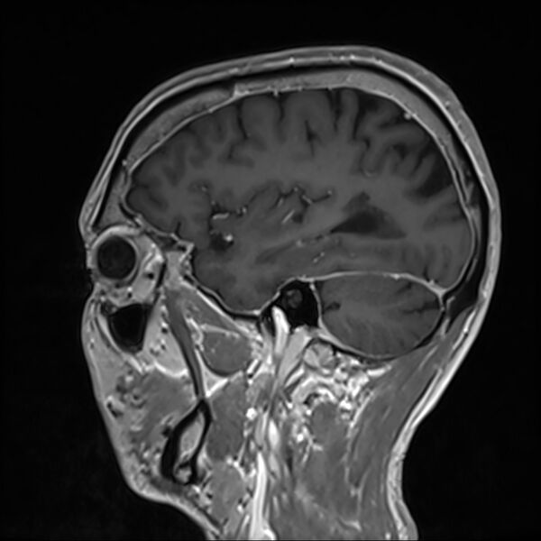 File:Cervical dural CSF leak on MRI and CT treated by blood patch (Radiopaedia 49748-54995 G 89).jpg