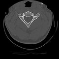 Cervical flexion teardrop fracture with cord hemorrhage (Radiopaedia 32497-33454 Axial bone window 26).jpg