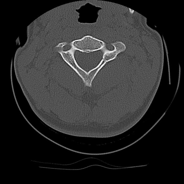 File:Cervical flexion teardrop fracture with cord hemorrhage (Radiopaedia 32497-33454 Axial bone window 26).jpg