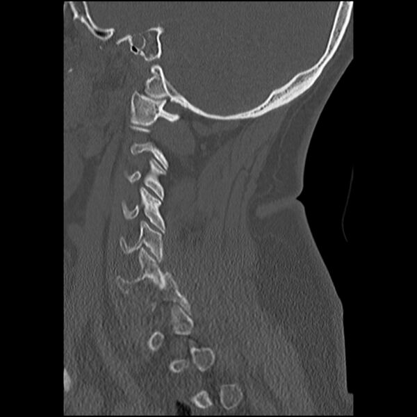 File:Cervical fracture and dislocation with locked facet (Radiopaedia 31837-32780 Sagittal bone window 28).jpg