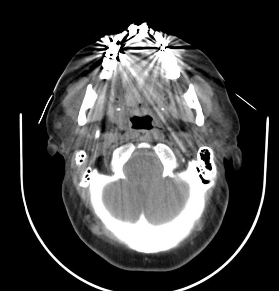 File:Cervical lymphadenopathy- cause unknown (Radiopaedia 22420-22457 non-contrast 34).jpg