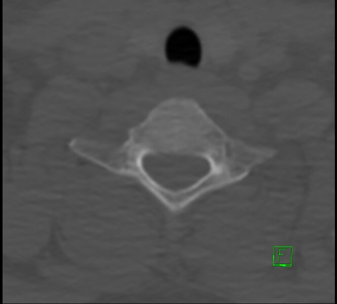 File:Cervical spine fracture - hyperflexion injury (Radiopaedia 66184-75364 Axial bone window 46).jpg