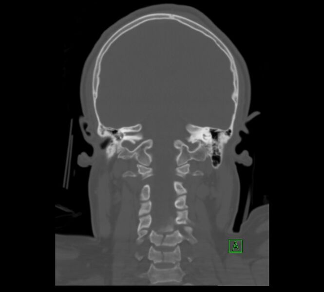 File:Cervical spine fracture - hyperflexion injury (Radiopaedia 66184-75364 Coronal bone window 7).jpg