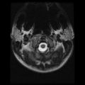 Cervical vertebrae metastasis (Radiopaedia 78814-91667 Axial T2 26).png