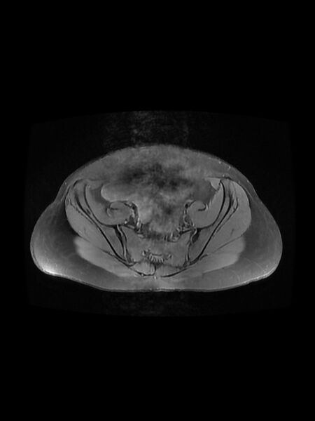 File:Cesarean section scar endometrioma (Radiopaedia 56569-63297 Axial PD fat sat 13).jpg