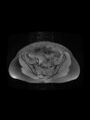 Cesarean section scar endometrioma (Radiopaedia 56569-63297 Axial PD fat sat 13).jpg