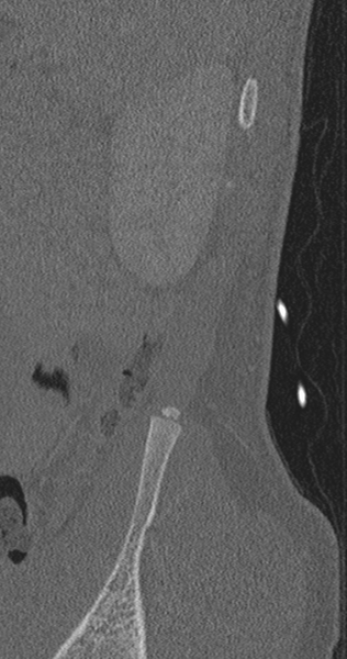 File:Chance fracture (Radiopaedia 40360-42912 Sagittal bone window 2).png