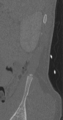 Chance fracture (Radiopaedia 40360-42912 Sagittal bone window 2).png