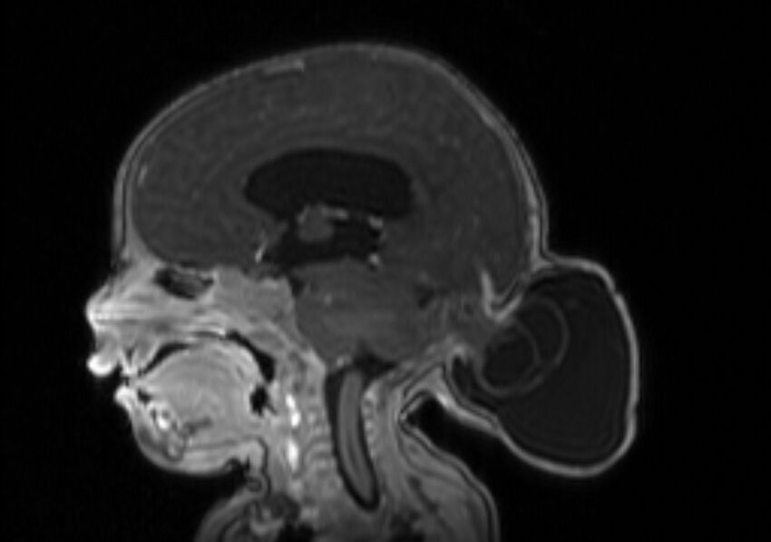 Chiari III malformation with occipital encephalocele (Radiopaedia 79446-92559 Sagittal T1 C+ mpr 35).jpg
