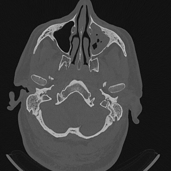 File:Cholesteatoma (Radiopaedia 68176-77673 Axial bone window 4).jpg