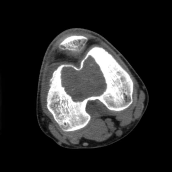 File:Chondroblastoma - distal femur (Radiopaedia 8112-8950 Axial non-contrast 1).jpg