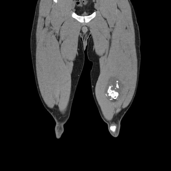 File:Chondrosarcoma arising from exostosis (Radiopaedia 59996-67507 Coronal soft tissue 4).jpg