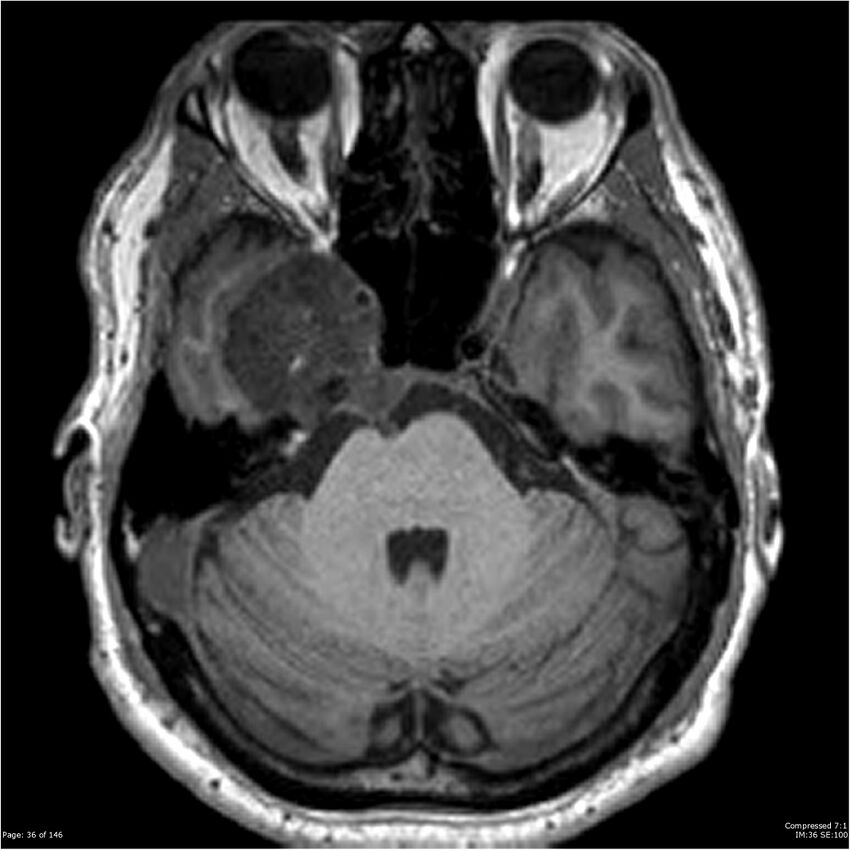 Chondrosarcoma of skull base- grade II (Radiopaedia 40948-43654 Axial T1 36).jpg