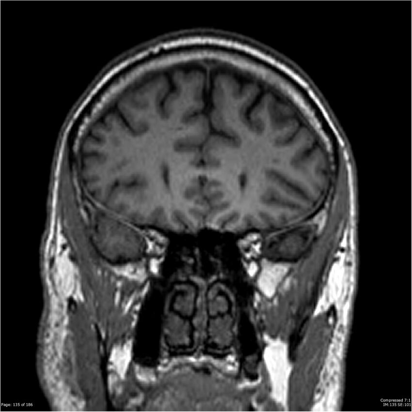 Chondrosarcoma of skull base- grade II (Radiopaedia 40948-43654 Coronal T1 56).jpg