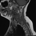 Chordoma (C4 vertebra) (Radiopaedia 47561-52189 Sagittal T1 13).png