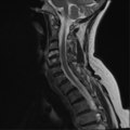 Chordoma (C4 vertebra) (Radiopaedia 47561-52189 Sagittal T2 5).png