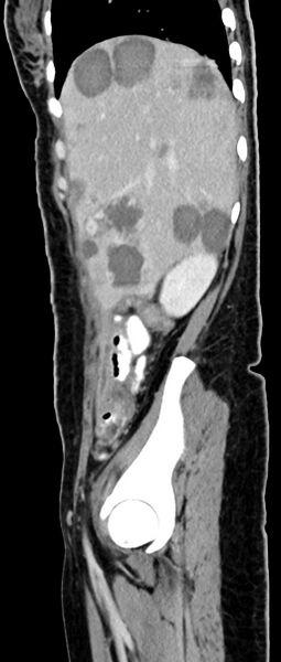 File:Choriocarcinoma liver metastases (Radiopaedia 74768-85766 C 134).jpg
