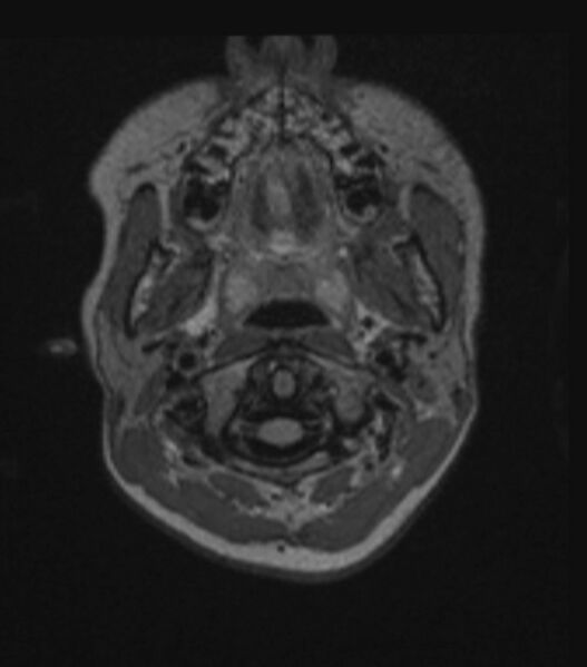File:Choroid plexus carcinoma (Radiopaedia 91013-108553 Axial FLAIR C+ 58).jpg