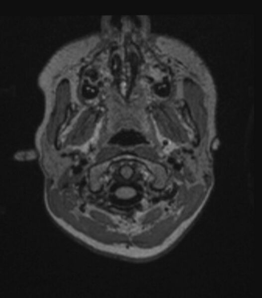 File:Choroid plexus carcinoma (Radiopaedia 91013-108553 Axial FLAIR C+ 61).jpg
