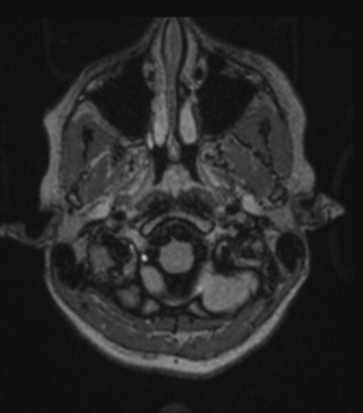 File:Choroid plexus carcinoma (Radiopaedia 91013-108553 Axial FLAIR C+ 78).jpg