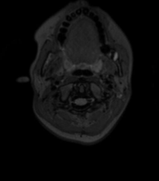 File:Choroid plexus carcinoma (Radiopaedia 91013-108553 Axial T2 fat sat 12).jpg
