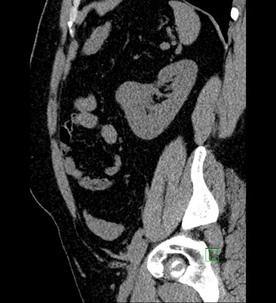 File:Chromophobe renal cell carcinoma (Radiopaedia 84286-99573 C 47).jpg