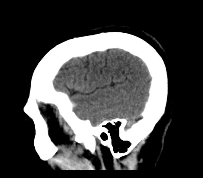 File:Chronic bilateral occipital lobe infarcts (Radiopaedia 31276-31996 C 8).jpg