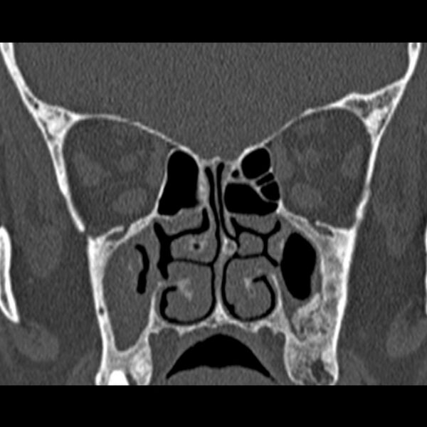 File:Chronic maxillary sinusitis (Radiopaedia 27879-28116 Coronal bone window 29).jpg