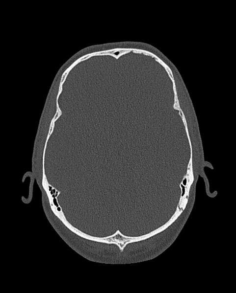 File:Chronic maxillary sinusitis caused by a foreign body (Radiopaedia 58521-65676 Axial bone window 312).jpg