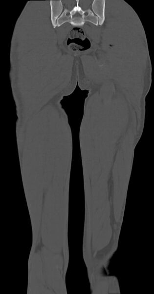 File:Chronic osteomyelitis (with sequestrum) (Radiopaedia 74813-85822 Coronal non-contrast 46).jpg
