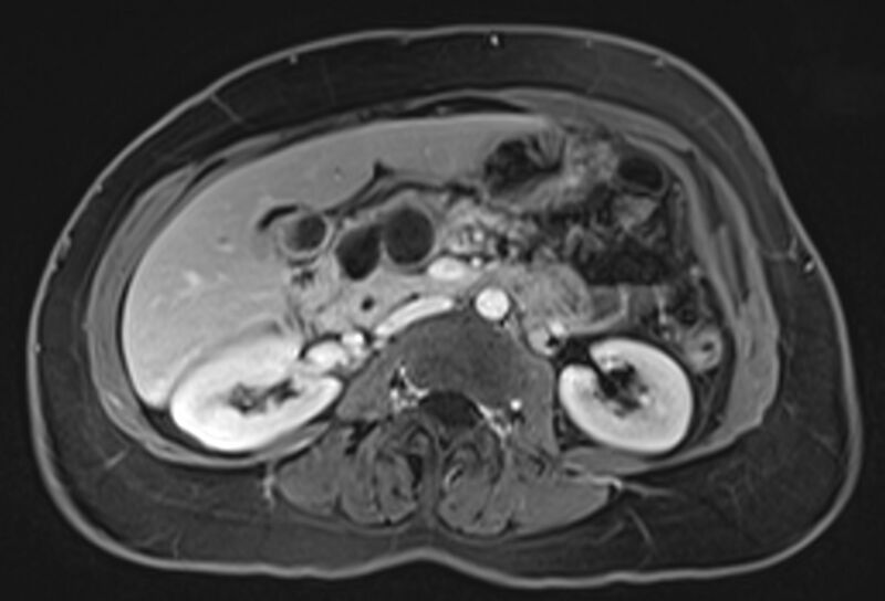 File:Chronic pancreatitis - pancreatic duct calculi (Radiopaedia 71818-82250 Axial T1 C+ fat sat 36).jpg
