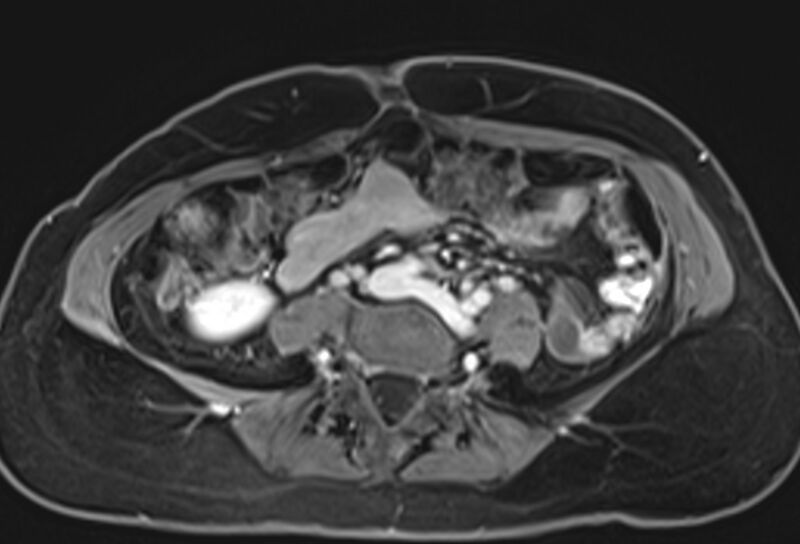 File:Chronic pancreatitis - pancreatic duct calculi (Radiopaedia 71818-82250 Axial T1 C+ fat sat 56).jpg