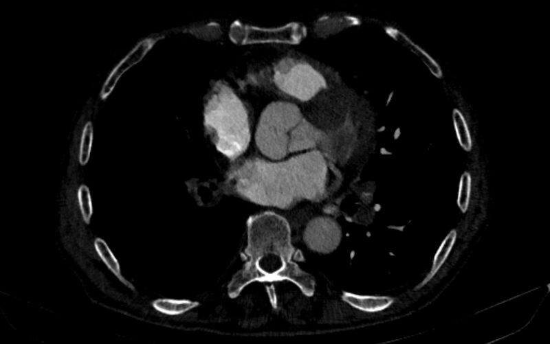 File:Chronic pulmonary embolism (Radiopaedia 91241-108843 B 115).jpg