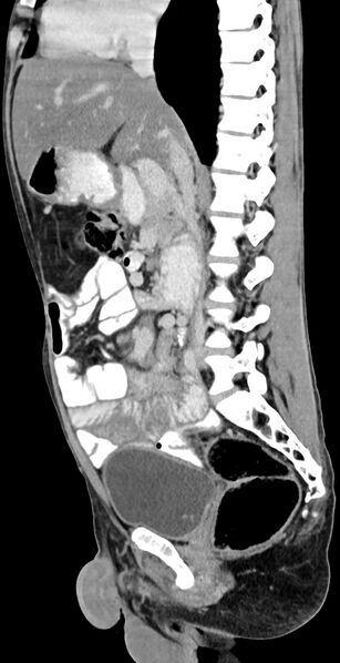 File:Chronic small bowel volvulus (Radiopaedia 75224-86322 C 82).jpg