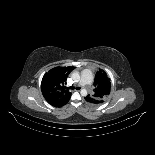 File:Chronic thromboembolic pulmonary hypertension (CTEPH) (Radiopaedia 74597-85532 Axial C+ CTPA 104).jpg