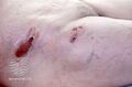 Cicatricial pemphigoid (DermNet NZ immune-cic-pem1).jpg