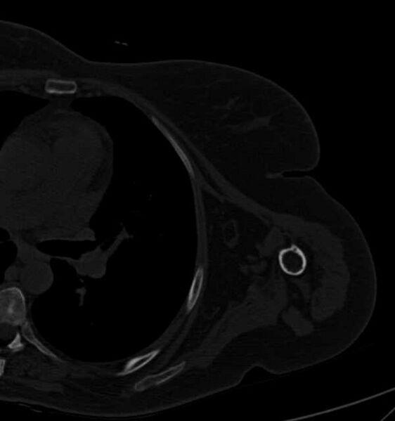 File:Clear cell chondrosarcoma - humerus (Radiopaedia 63104-71612 Axial bone window 80).jpg