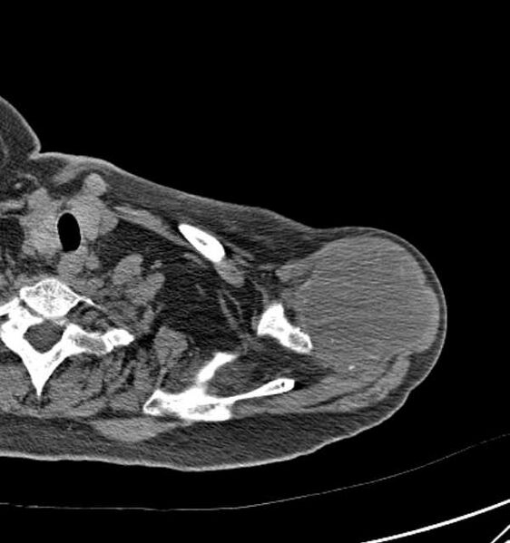 File:Clear cell chondrosarcoma - humerus (Radiopaedia 63104-71612 Axial non-contrast 21).jpg