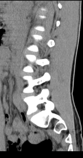 File:Clear cell meningoma - lumbar spine (Radiopaedia 60116-67691 A 30).png