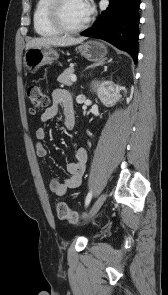 File:Clear cell renal cell carcinoma (Radiopaedia 61449-69393 G 38).jpg