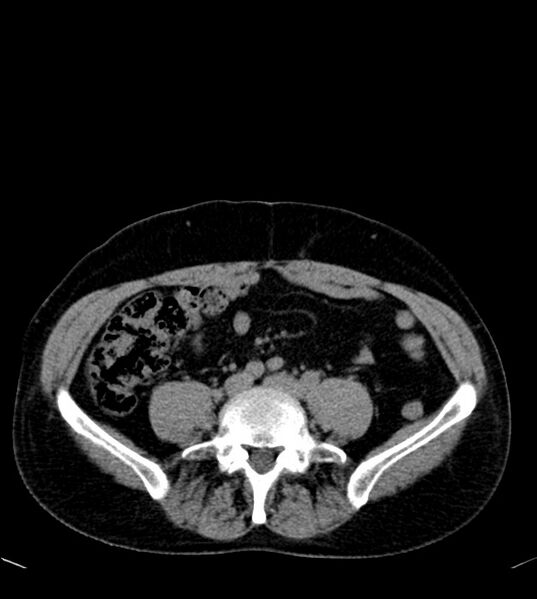 File:Clear cell renal cell carcinoma (Radiopaedia 85006-100539 Axial non-contrast 59).jpg