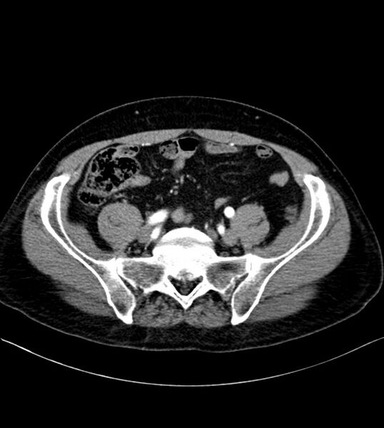 File:Clear cell renal cell carcinoma (Radiopaedia 85006-100539 B 66).jpg