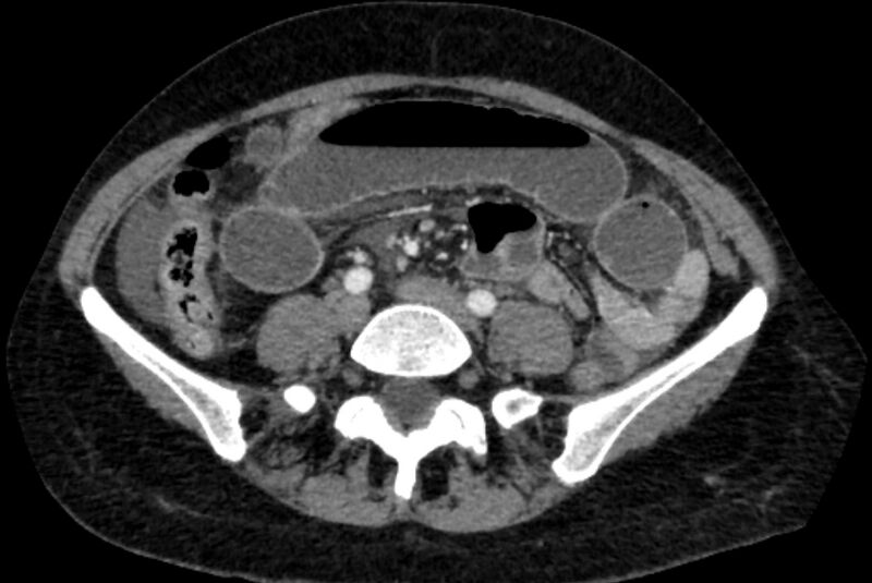 File:Closed loop small bowel obstruction (Radiopaedia 71211-81508 A 87).jpg