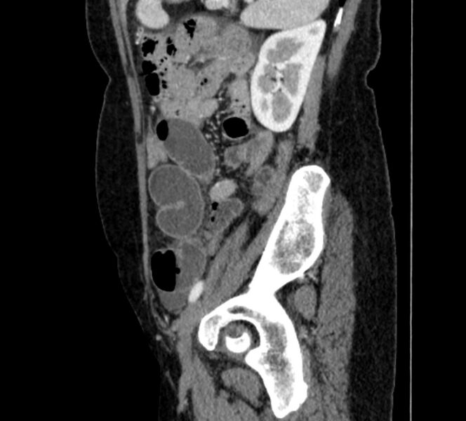 File:Closed loop small bowel obstruction (Radiopaedia 71211-81508 C 125).jpg