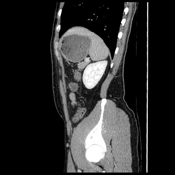 File:Co-existing acute appendicitis and epiploic appendagitis (Radiopaedia 61789-69911 B 76).jpg