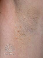 Fox-Fordyce disease (DermNet NZ hair-nails-sweat-fox-fordyce2).jpg