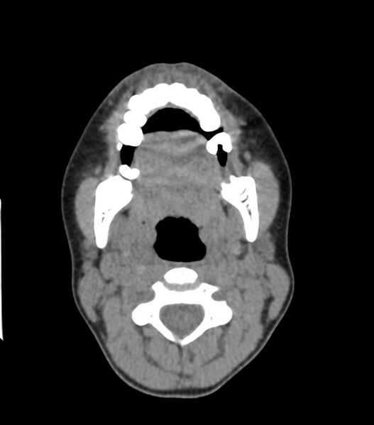 File:Nasoorbitoethmoid fracture (Radiopaedia 90044-107205 Axial non-contrast 78).jpg