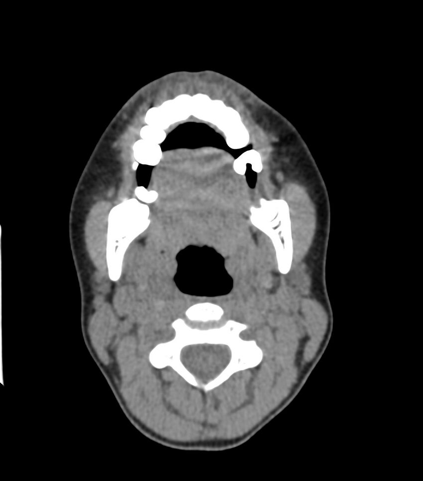 Nasoorbitoethmoid fracture (Radiopaedia 90044-107205 Axial non-contrast 78).jpg